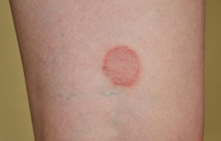 Lesioni Cutanee Fungine: Tipi, Cause e Trattamenti