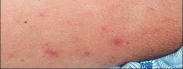 Lesioni Cutanee nell'HIV: Cause, Tipi e Trattamenti