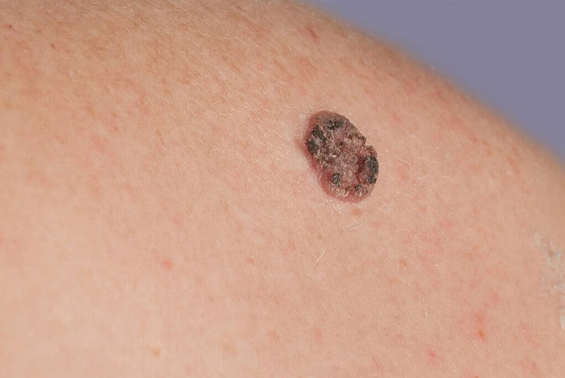 Lesioni della Pelle Epiteliali: Tipologie, Cause e Trattamenti