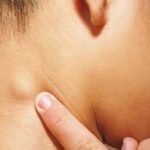 Allergie e Linfonodi: Come Sono Collegati