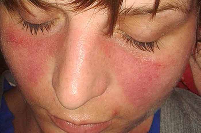 Lesioni Cutanee nell'Endocardite: Sintomi, Tipi e Trattamenti