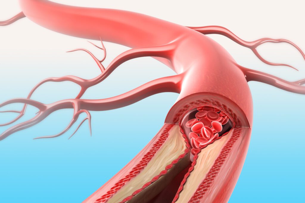 Aterosclerosi Avanzata: Cause, Sintomi, Complicazioni e Trattamenti