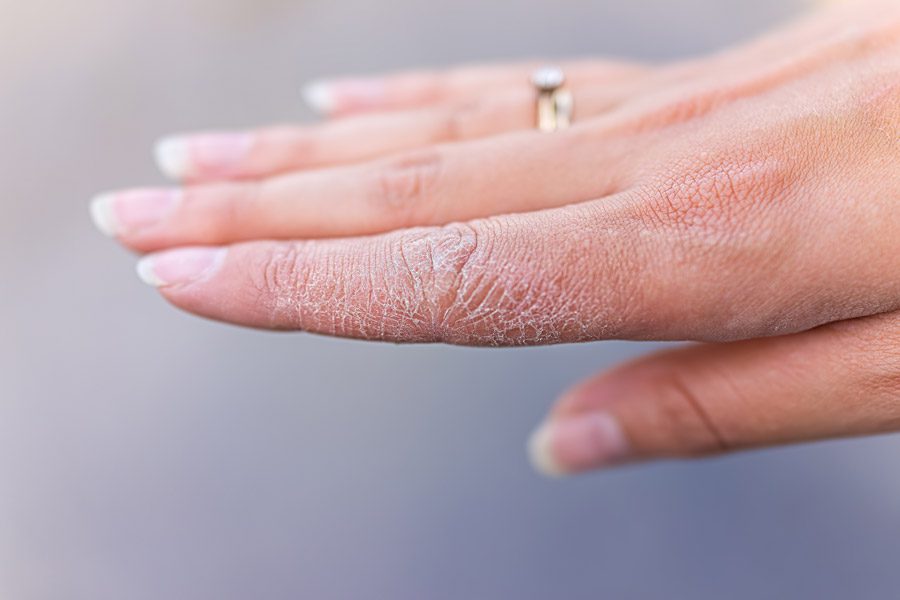 Mani Ruvide: Cause e Rimedi Efficaci per Ammorbidirle