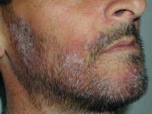 Micosi nella Barba: Comprendere la Condizione