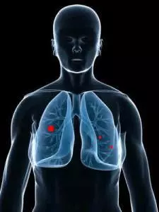 Nodulo fibrocalcifico: Cos’è, cause e trattamenti