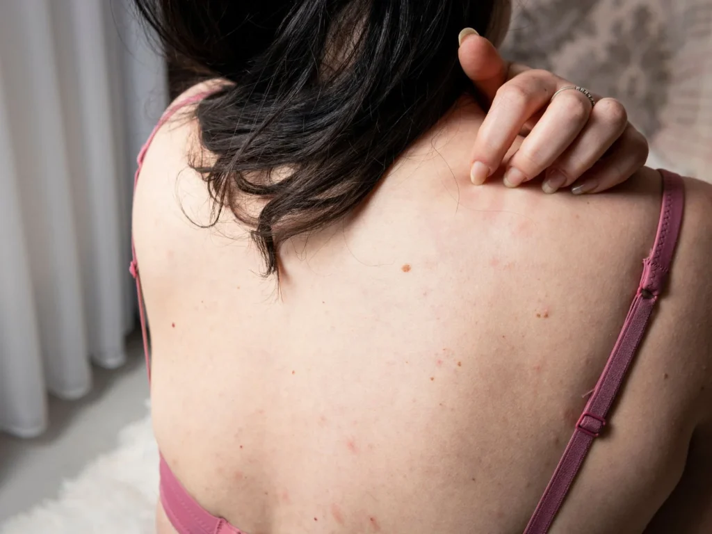 Orticaria da Mare: Cause, Sintomi e Rimedi