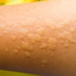 Orticaria Alimentare: Guida Completa