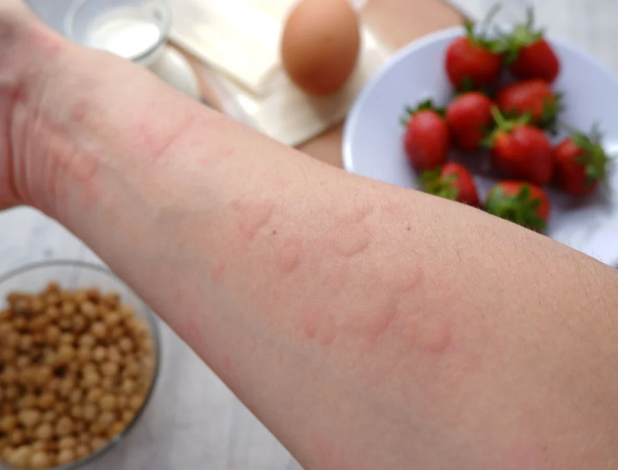 Orticaria da Cibo: Sintomi, Cause e Trattamenti