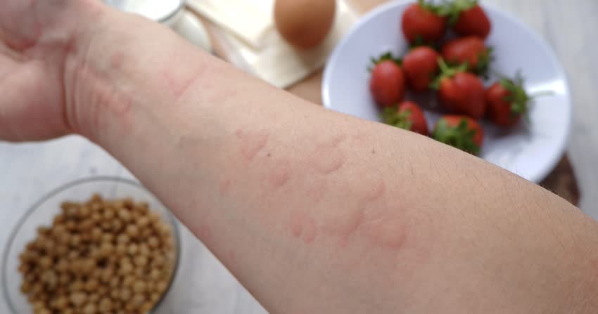 Orticaria da fragole: Cause, sintomi e trattamenti