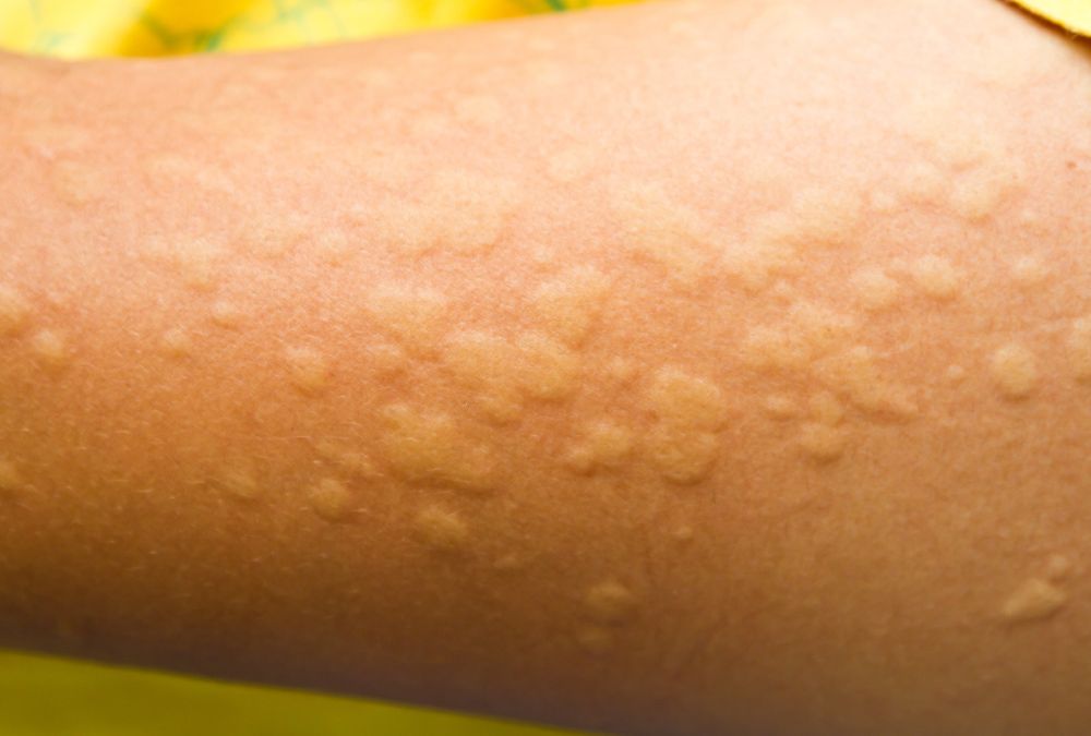 Orticaria su Braccia e Gambe: Cause, Sintomi e Rimedi