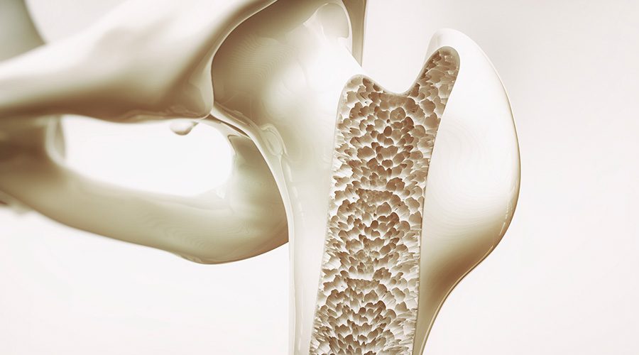 Osteoporosi dopo i 45 Anni: Cause, Sintomi e Prevenzione