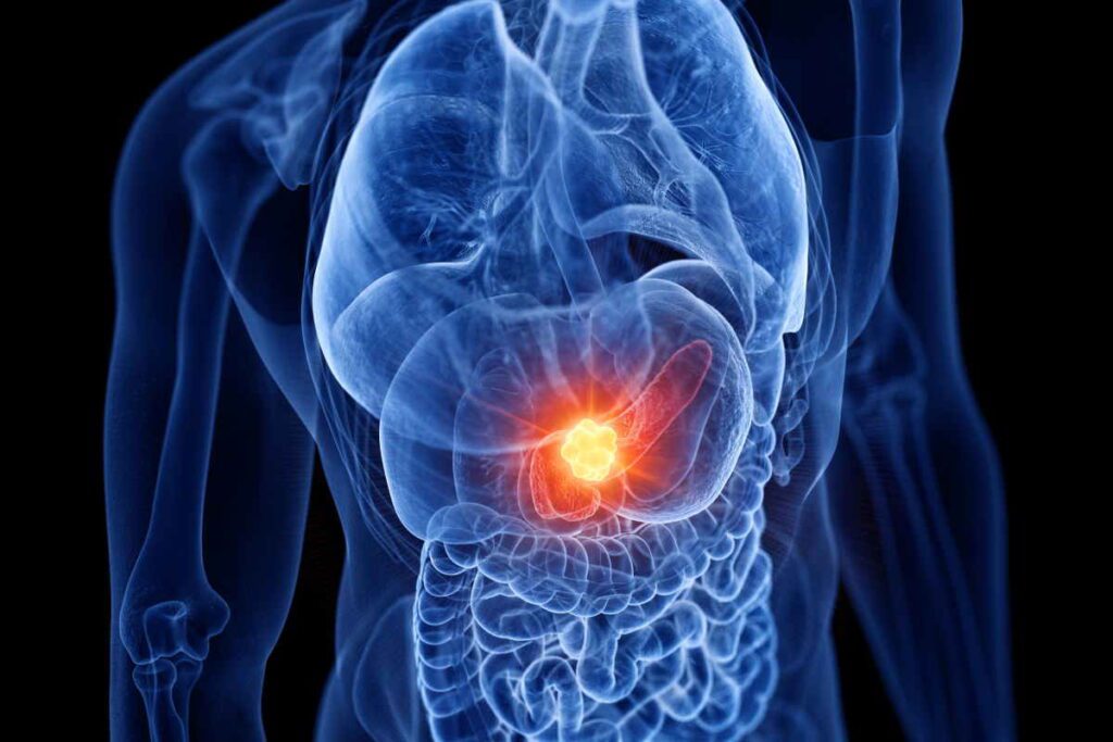Problemi al pancreas e gonfiore: Cause, sintomi e trattamenti
