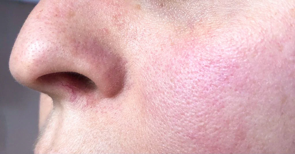 Pelle Sensibile sul Viso: Cause, Sintomi e Routine di Cura