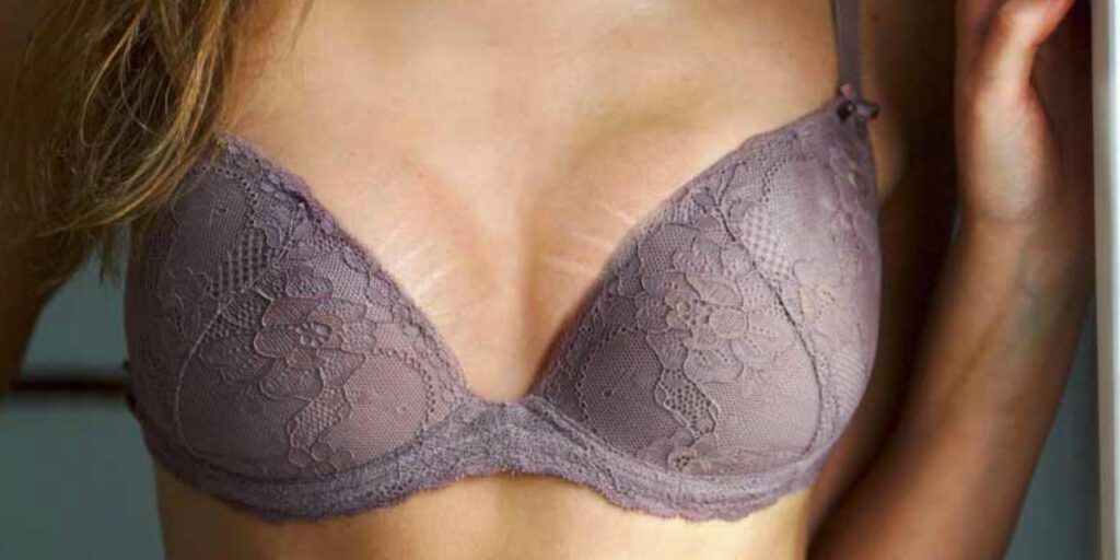 Smagliature sul Seno: Cause, Trattamenti e Prevenzione