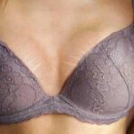Smagliature sul Seno: Cause, Trattamenti e Prevenzione