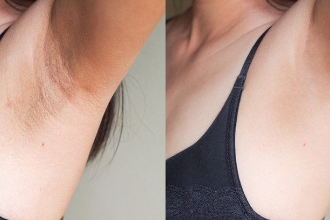 Smagliature sotto le Ascelle: Cause e Rimedi