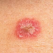 Lesioni della pelle causate dalla tigna