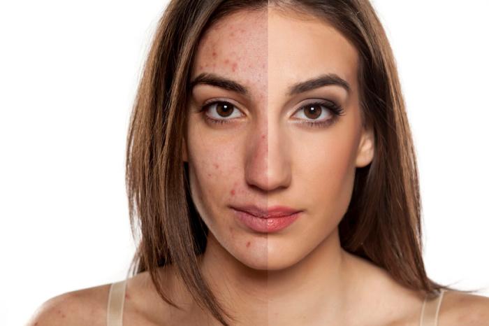 Trattamenti naturali per l'acne sul viso: Rimedi efficaci e consigli