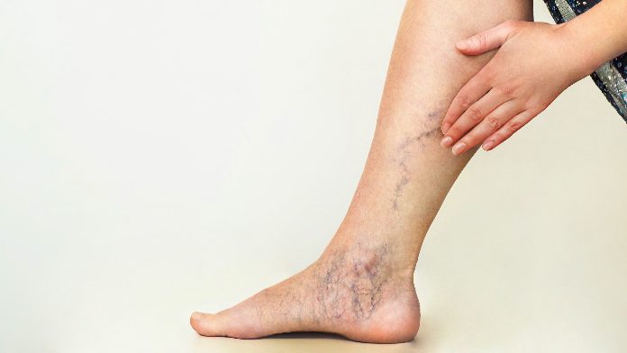 Trombosi alla Caviglia: Sintomi, Cause, Diagnosi e Trattamento