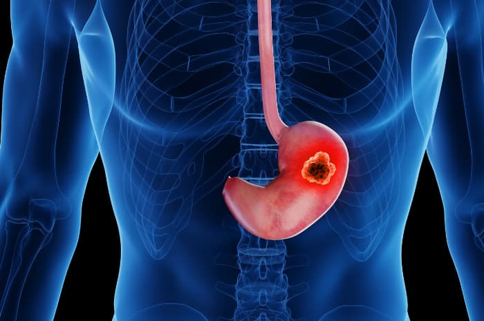 Individuare Precocemente un Tumore allo Stomaco: Sintomi, Diagnosi e Prevenzione