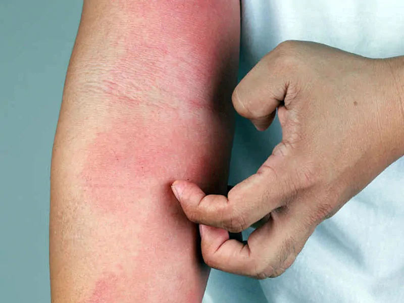 Dermatite da Sudore: Come Curarla