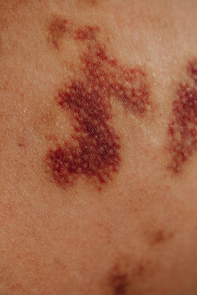 Macchie della pelle viola: cause, diagnosi e trattamenti