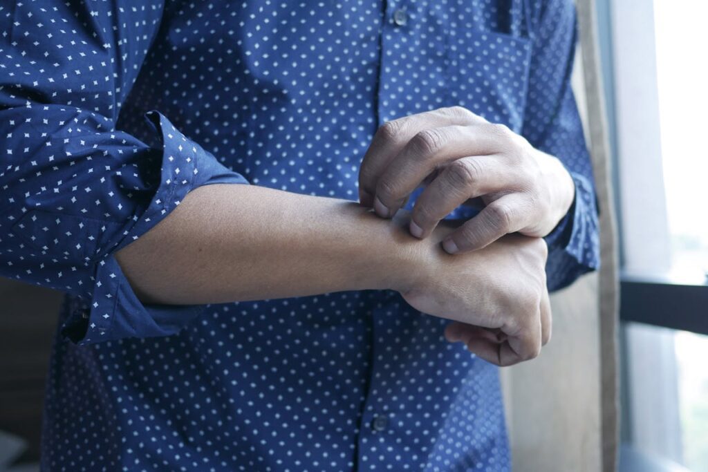 Orticaria acuta: cause, sintomi e trattamento