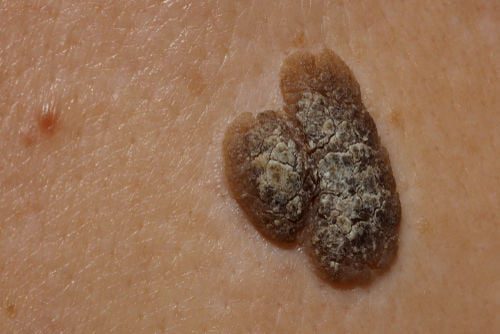 Caratteristiche delle Verruche Seborroiche