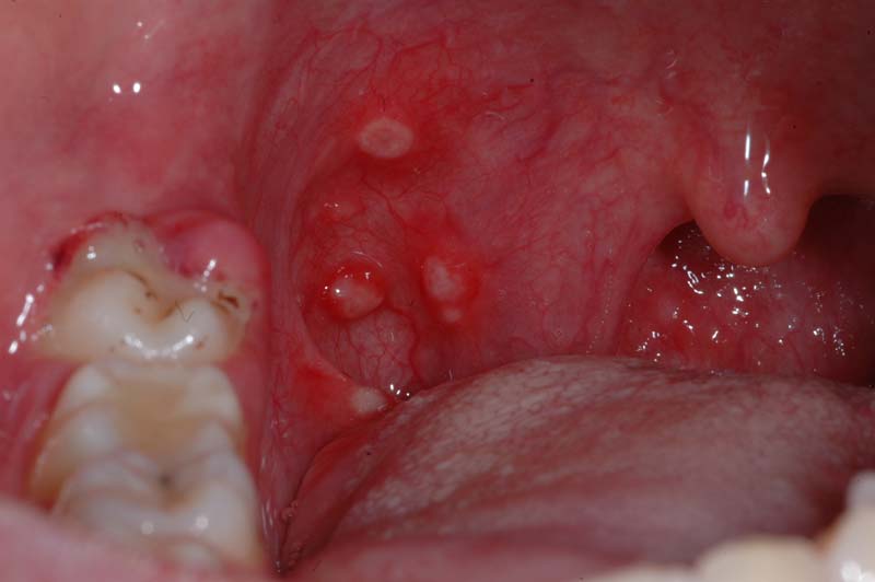 Afte nel Cavo Orale: Cause, Sintomi e Rimedi