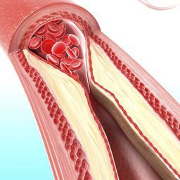Come Mantenere le Arterie Pulite: Alimenti e Stile di Vita