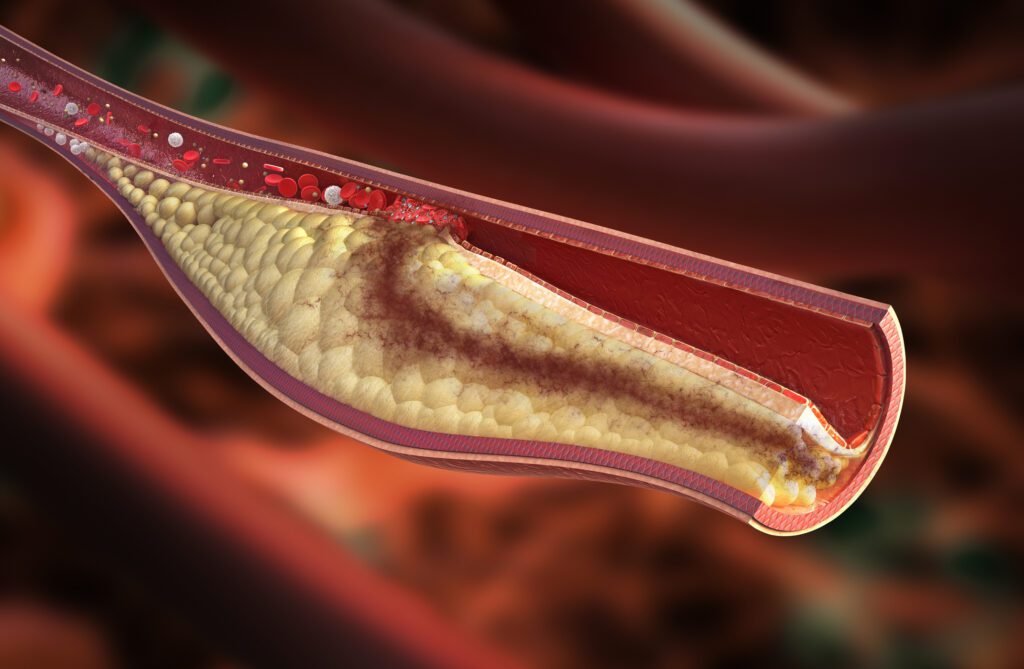 Arteriosclerosi a Placche