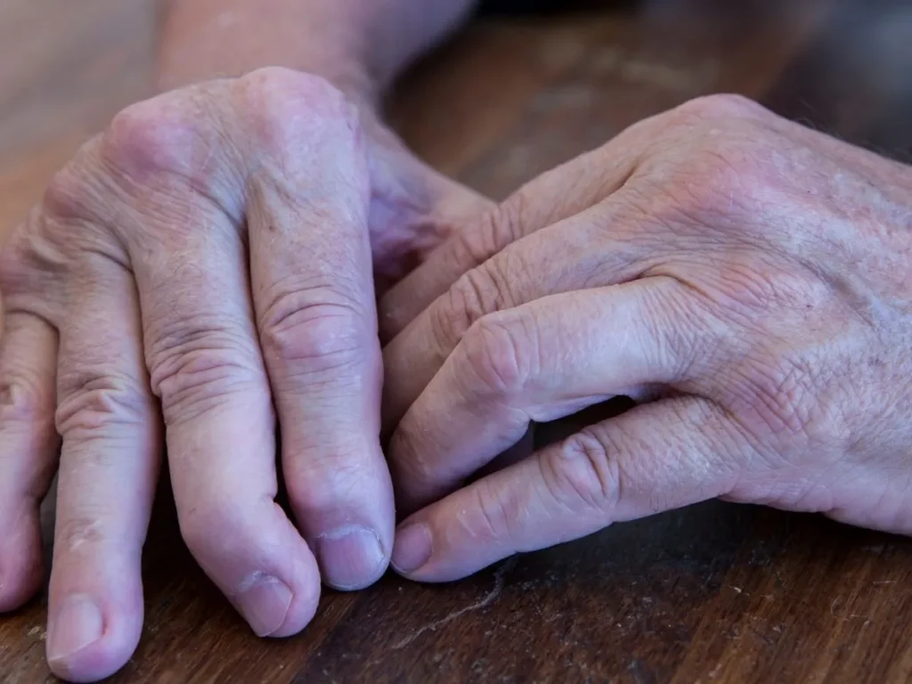 Artrite Psoriasica: Sintomi Iniziali e Indicazioni