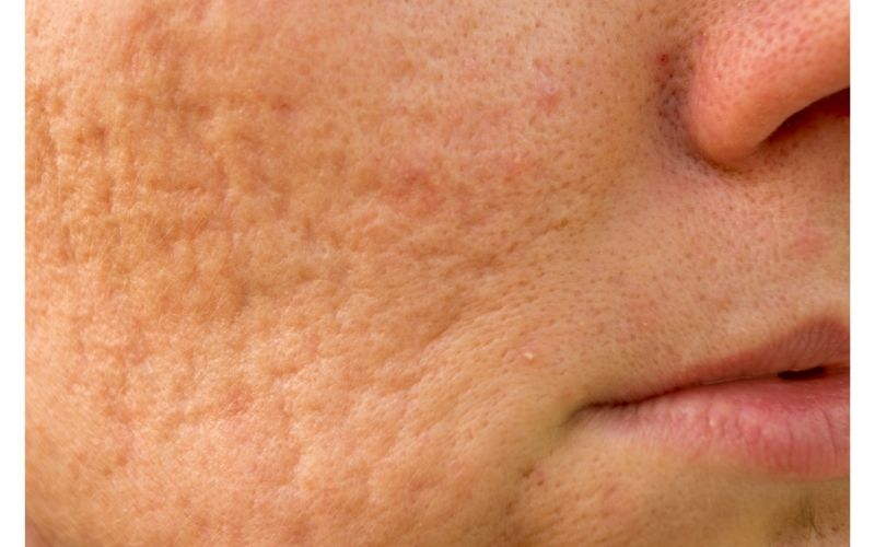 Come Far Sparire l'Acne: Trattamenti ed Abitudini Utili
