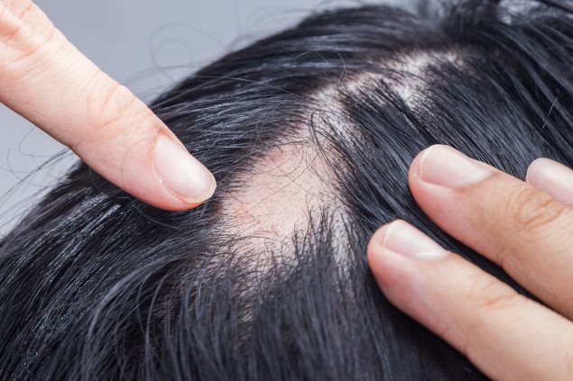 Cura per l'Alopecia