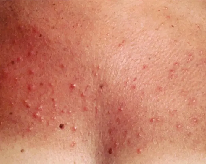 Dermatite Fotoallergica: Cause, Sintomi e Trattamenti