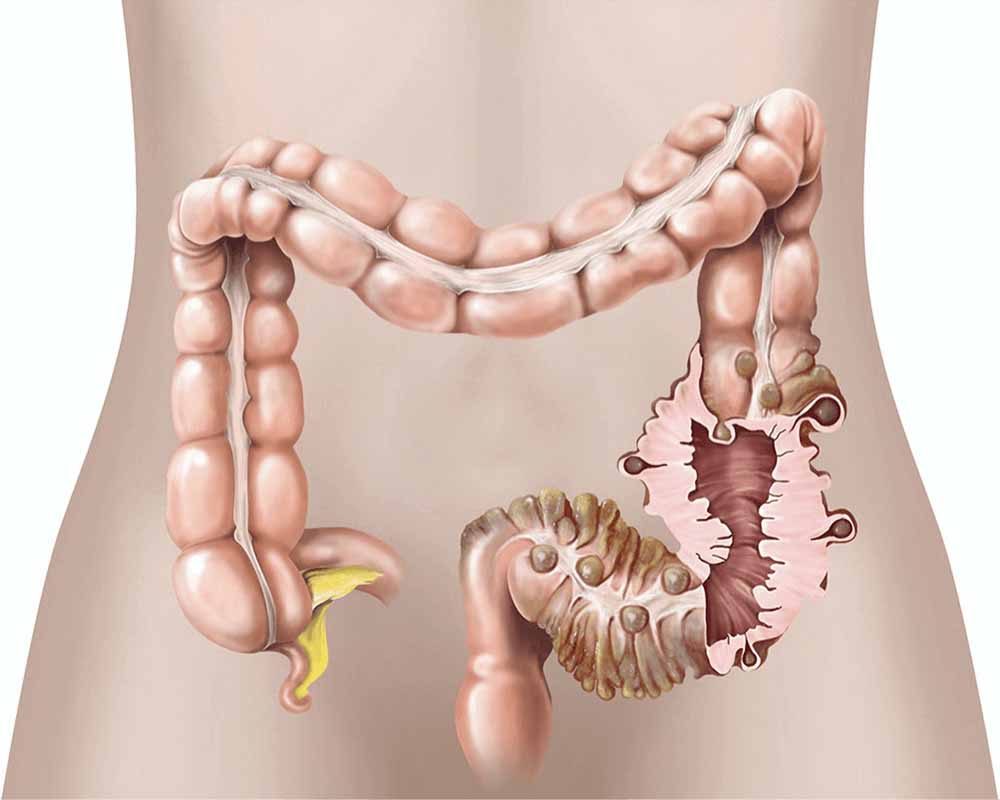 Alimenti da Evitare in Caso di Diverticolosi o Diverticolite