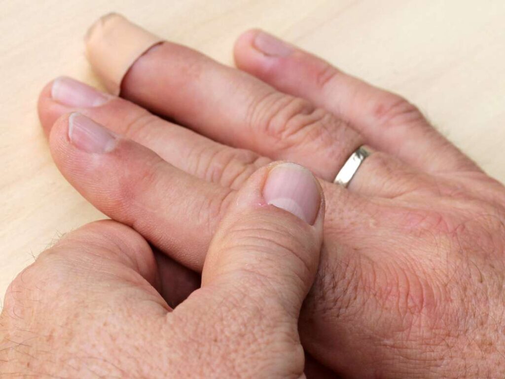 Artrite alle Dita delle Mani: Cause, Sintomi e Trattamenti