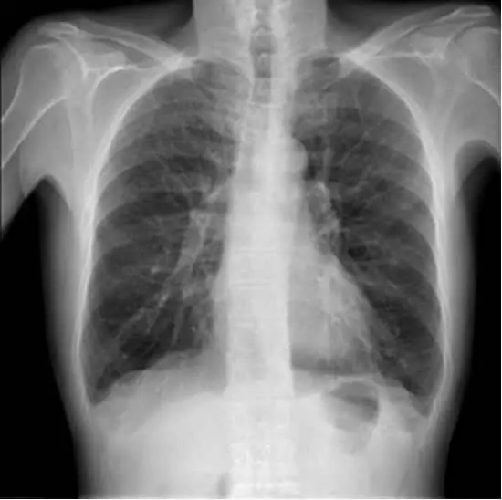Ruolo del Cortisone nel Trattamento dell’Enfisema