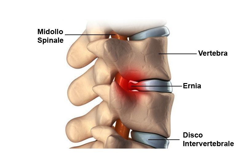 Le ernie discali cervicali