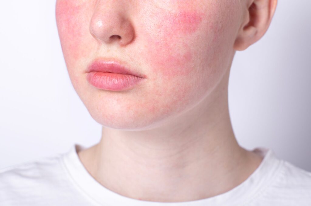 Malattie Comuni con il Freddo: Cause, Sintomi e Prevenzione