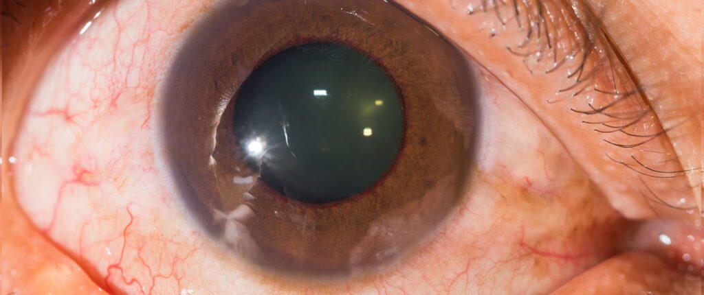 Il glaucoma a bassa pressione 
