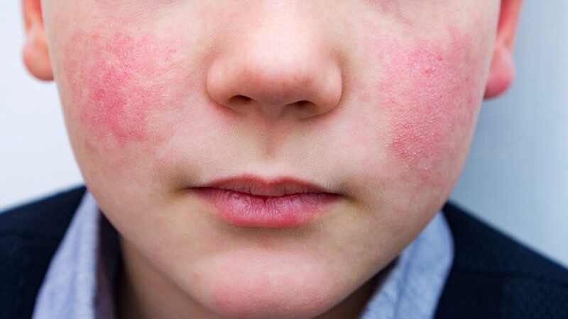 Guance Arrossate per il Freddo: Cause, Rimedi e Prevenzione
