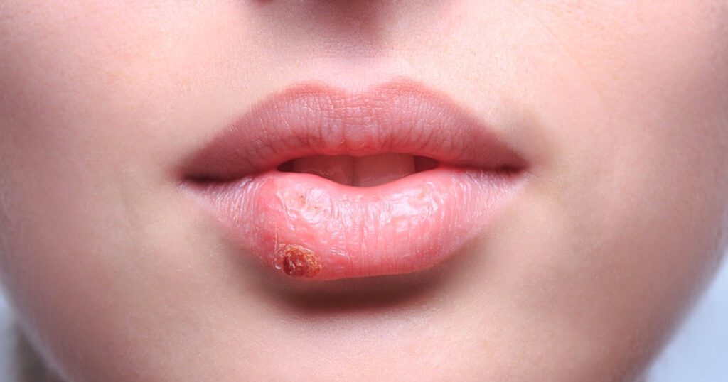 Come Lenire l’Herpes: Rimedi e Consigli
