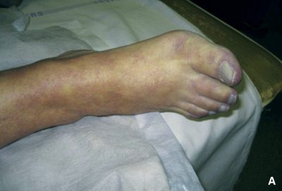 Ischemia Acuta: Cause, Sintomi e Trattamenti