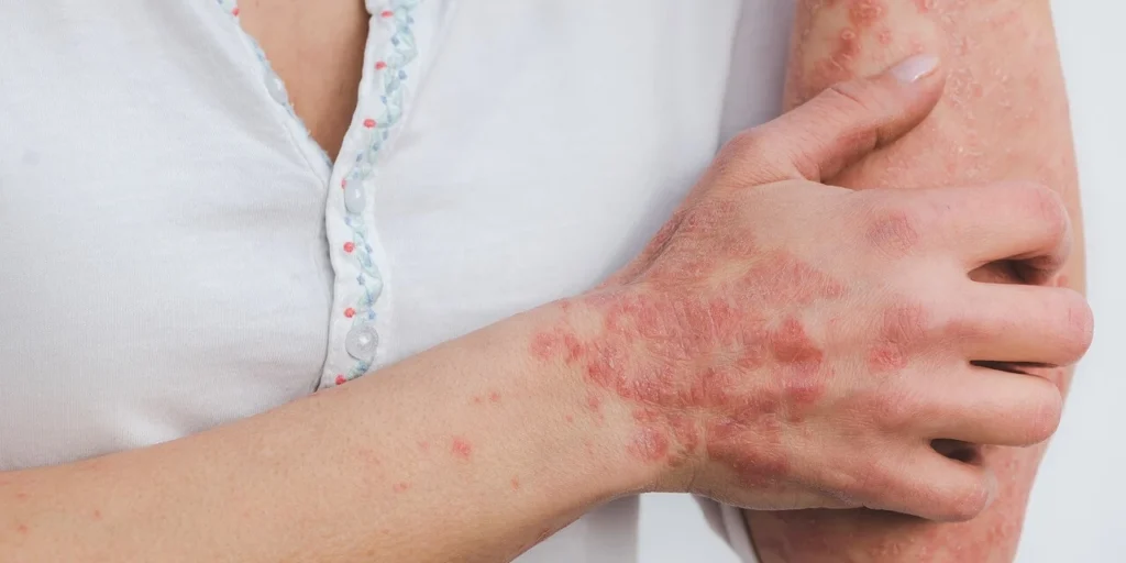 Macchie del Fegato sulla Pelle: Cause, Trattamenti e Prevenzione