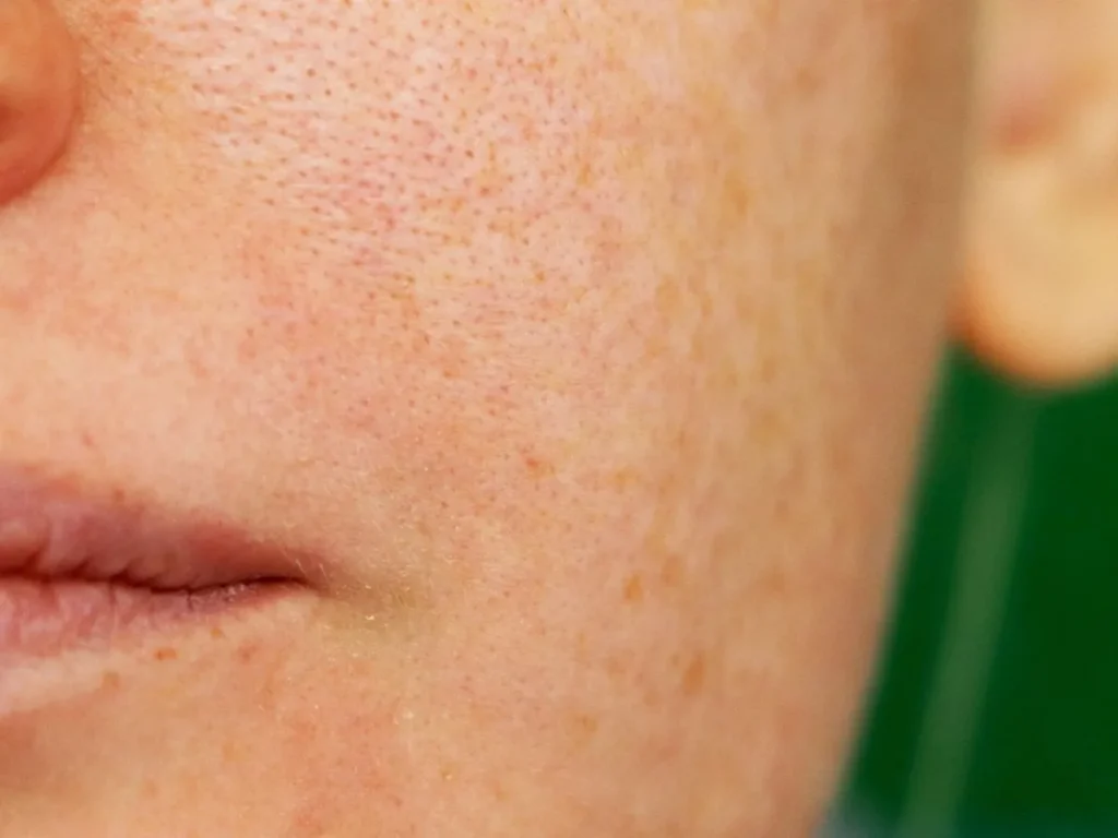 Macchie sulla Pelle in Menopausa: Cause, Trattamenti e Prevenzione