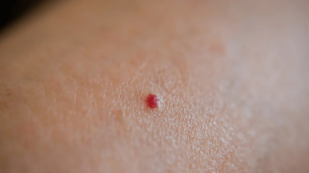 Macchie Rosse sulla Pelle: Cause, Tipologie e Rimedi