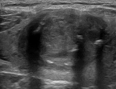 Il Nodulo Calcifico