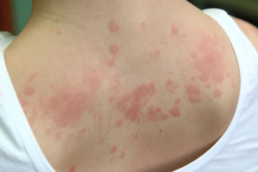 Tipi di Allergie Cutanee con Prurito