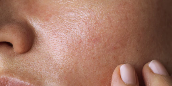 Pelle Screpolata: Cause, Rimedi e Prevenzione